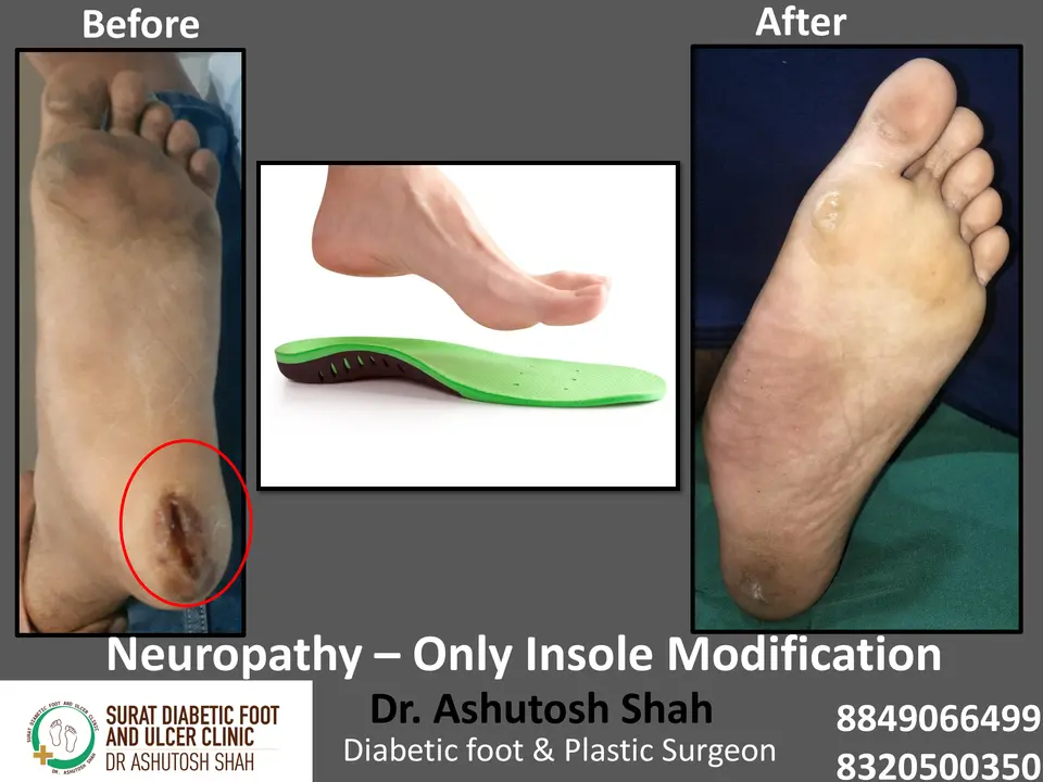 Diabetic Foot  PPT 3 checked by sir.pptx-74.webp